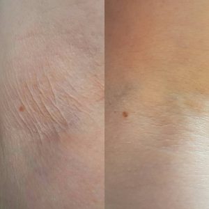 Crepey Skin Treatment Before and After