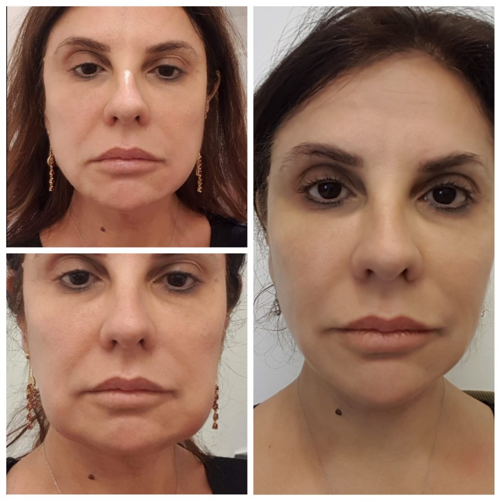 Best Treatment for Jowls