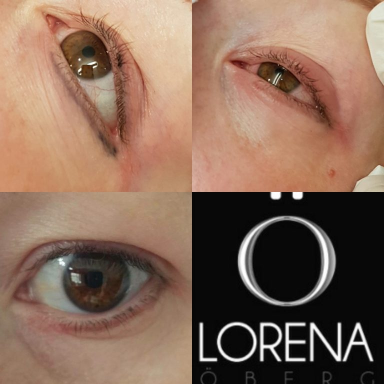 Tattoo Eyeliner Removal, Correction Migration Lorena Oberg