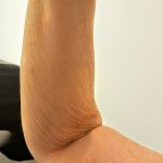 Wrinkled Arm Treatment