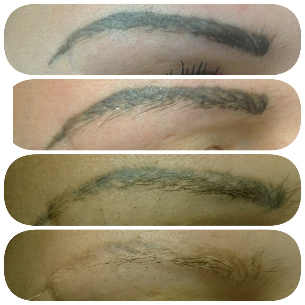 Tattoo Eyebrow Removal Before and After • Lorena Oberg