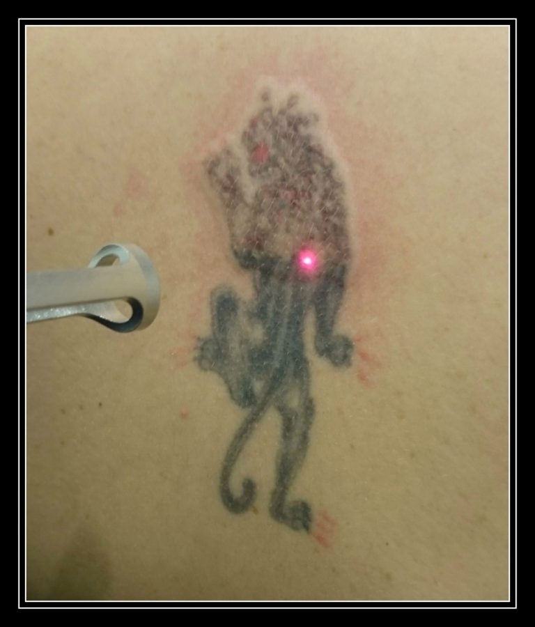 Laser Tattoo Removal London Experts London & Surrey