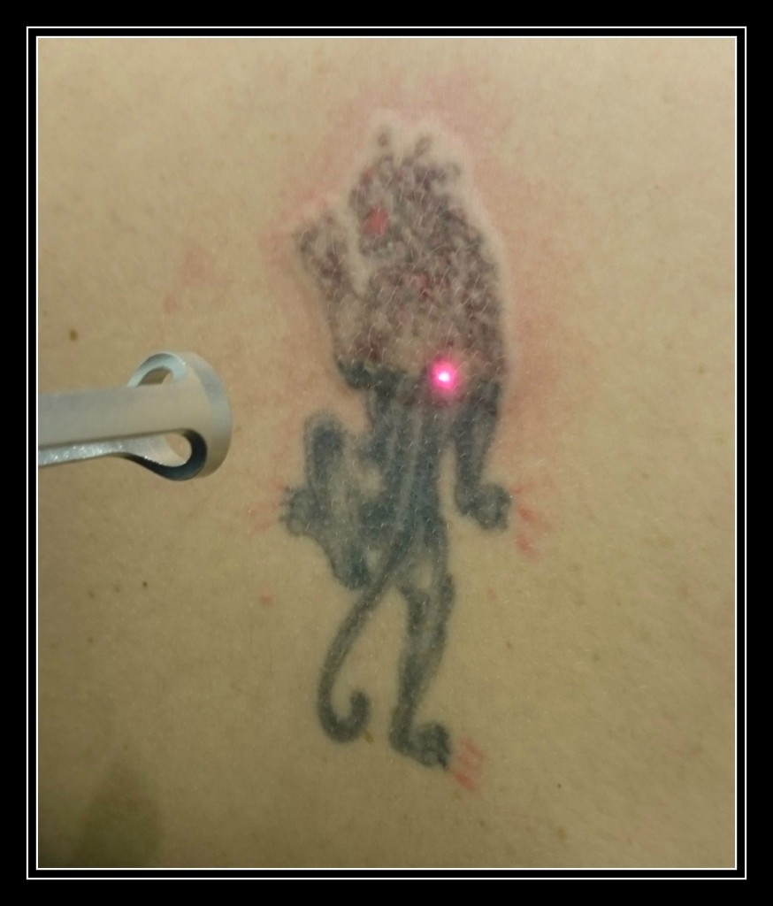 laser-tattoo-removal-london