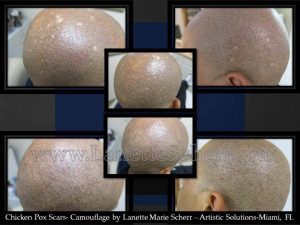 scalp micro pigmentation removal