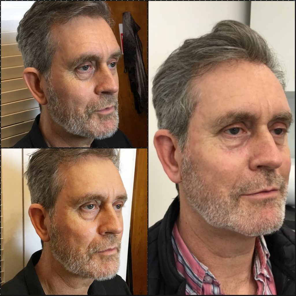 Male Filler Injections Before and After