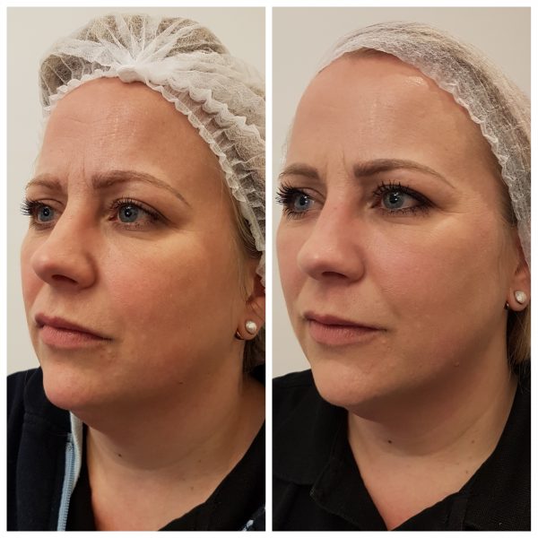 Jowl Lift Treatment Thread Lift For Jowls London Harley St Lorena