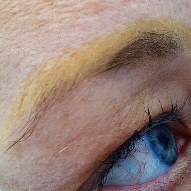 Laser removal of old microblading brows Clinical close-up of an Nd:YAG laser removing a dark eyebrow tattoo (تاتو الحواجب) safely without damaging the skin. نتائج إزالة تاتو حواجب قديم تحول إلى اللون الأزرق الرمادي باستخدام الليزر المتطور. Hurghada