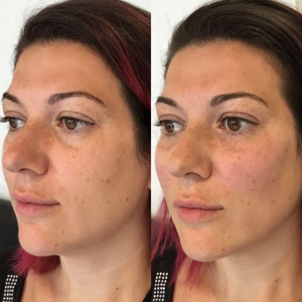 Natural Cheek dermal fillers on over 30s before and after in London