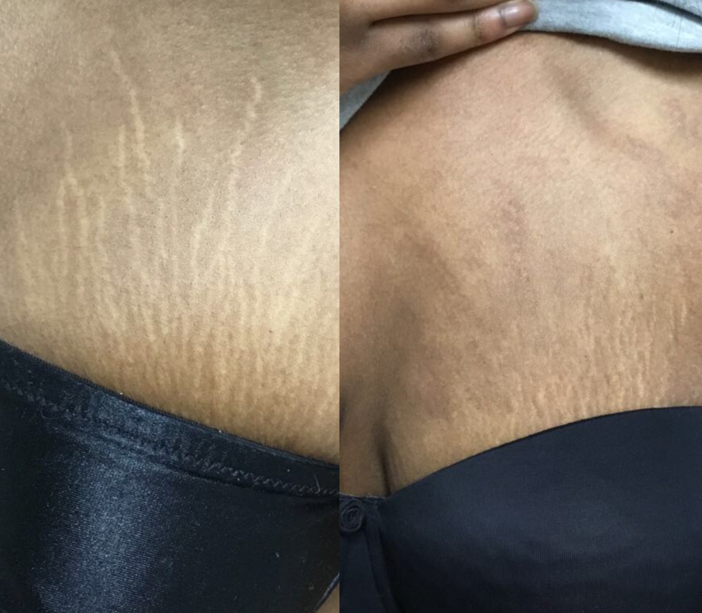 Dermaeraze stretch marks treatment on breast area in African black skin before and after.  London