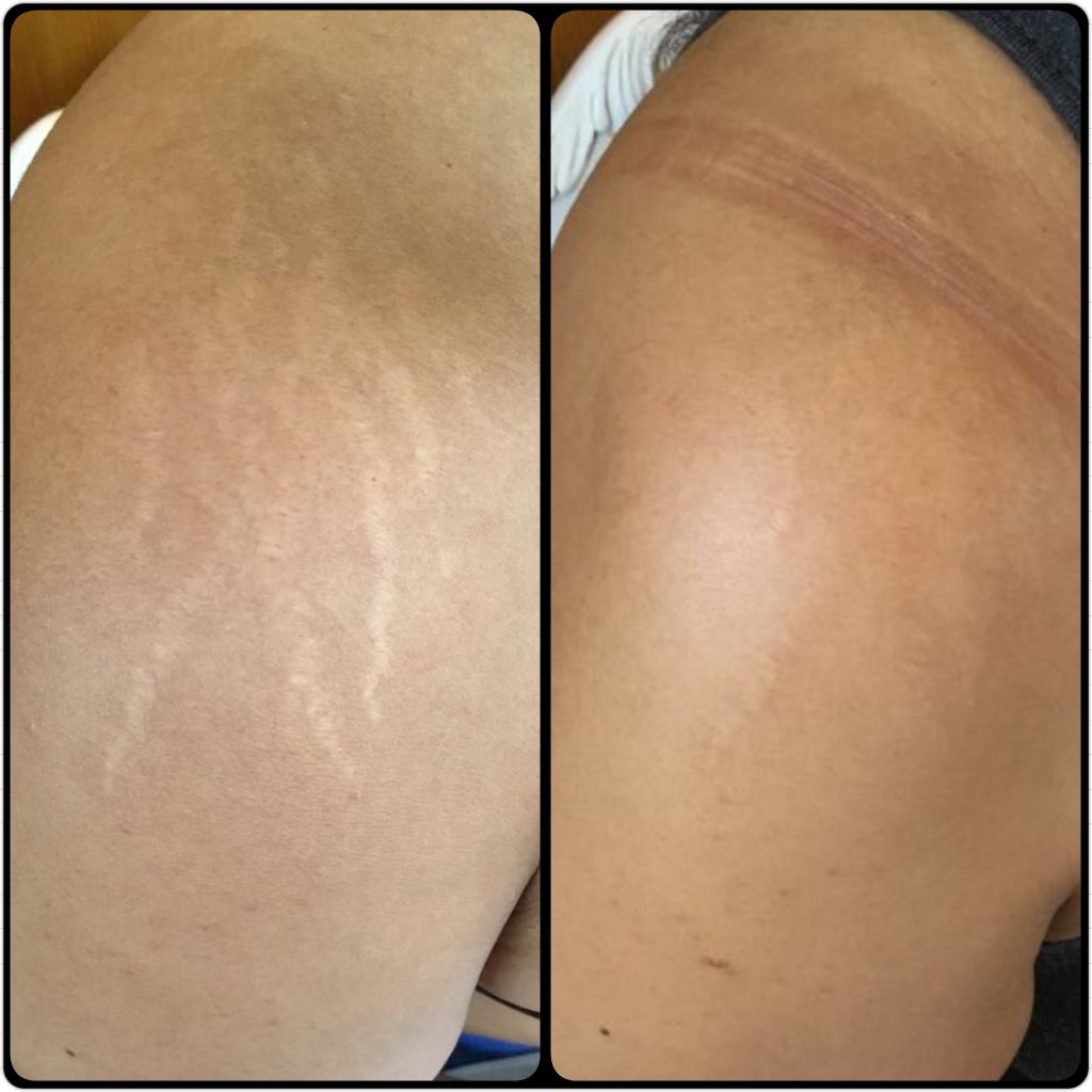 Stretch marks removal treatment on shoulders on African black skin before and after in London.