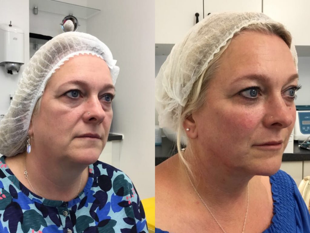 Cheek filler over 50 in London before and after