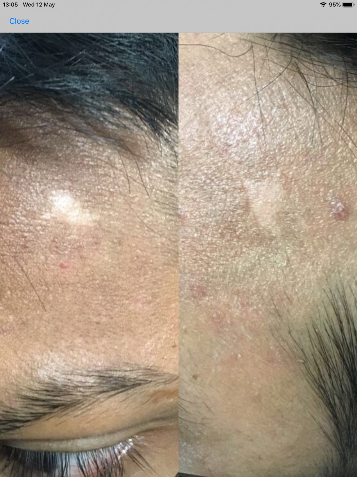 Hypopigmentation Treatment (White Scar) London Lorena Oberg