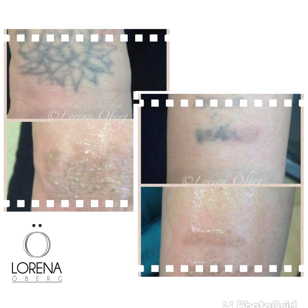 Laser tattoo removal in London before and after