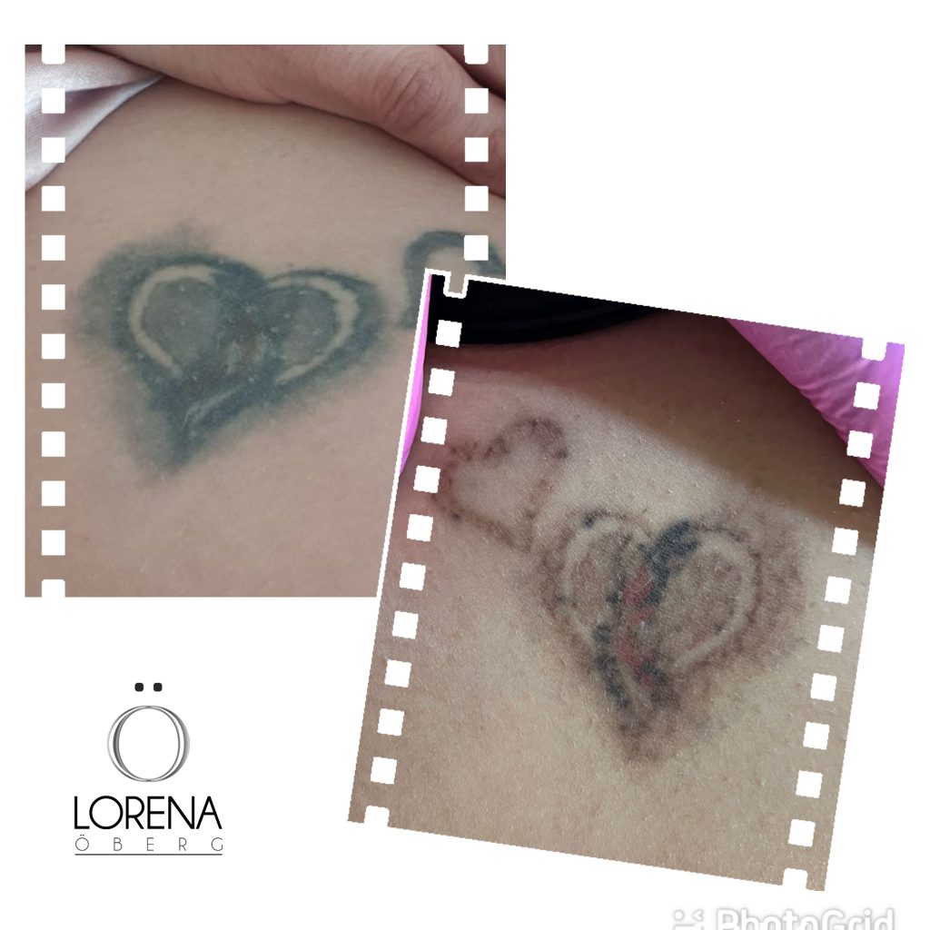 Laser tattoo removal after one treatment before and after in London. Tattoo removal expert