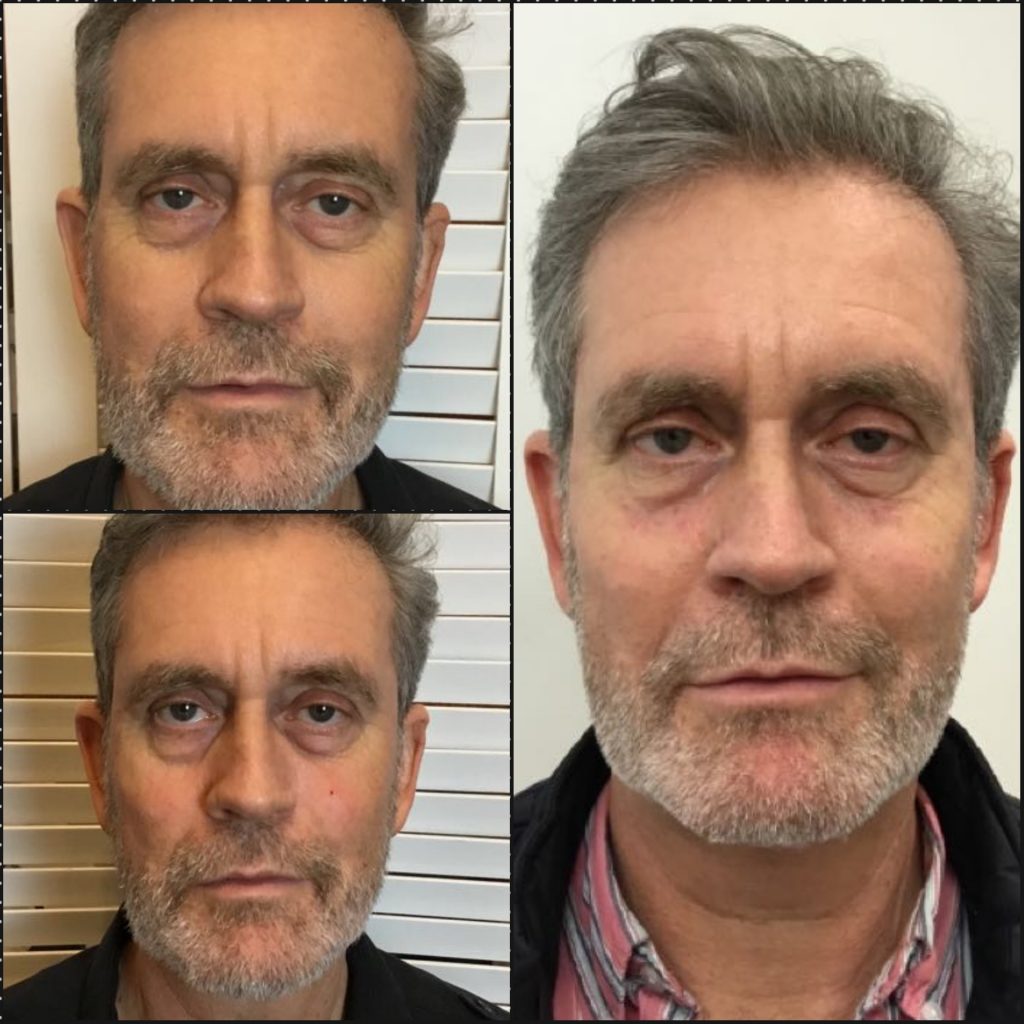 male facial fillers before and after