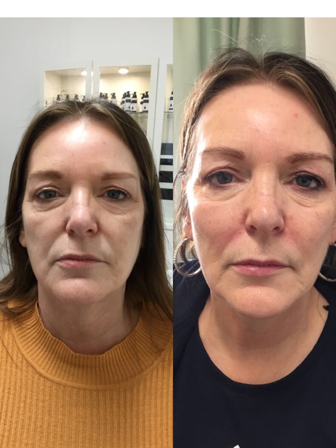 non surgical facelift in london using fillers before and after over 50