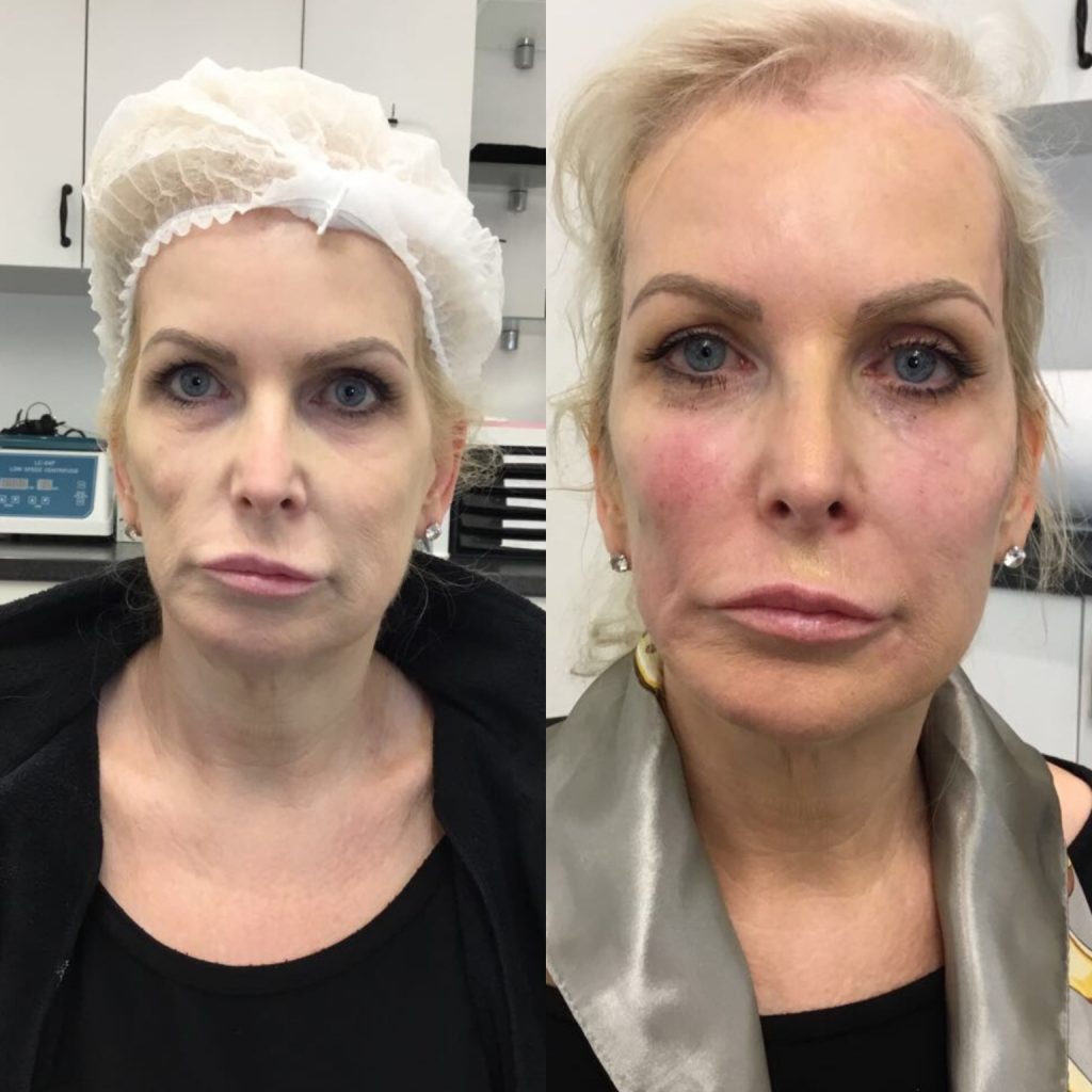non surgical facelift before and after in london using fillers for lady over 50