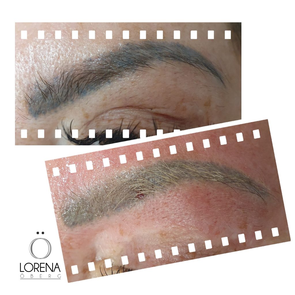 Permanent makeup eyebrow removal in London, Ashy brow