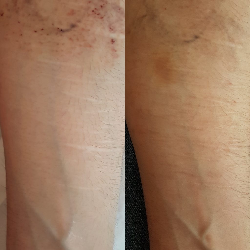 dermaeraze Self harm removal treatment in London before and after