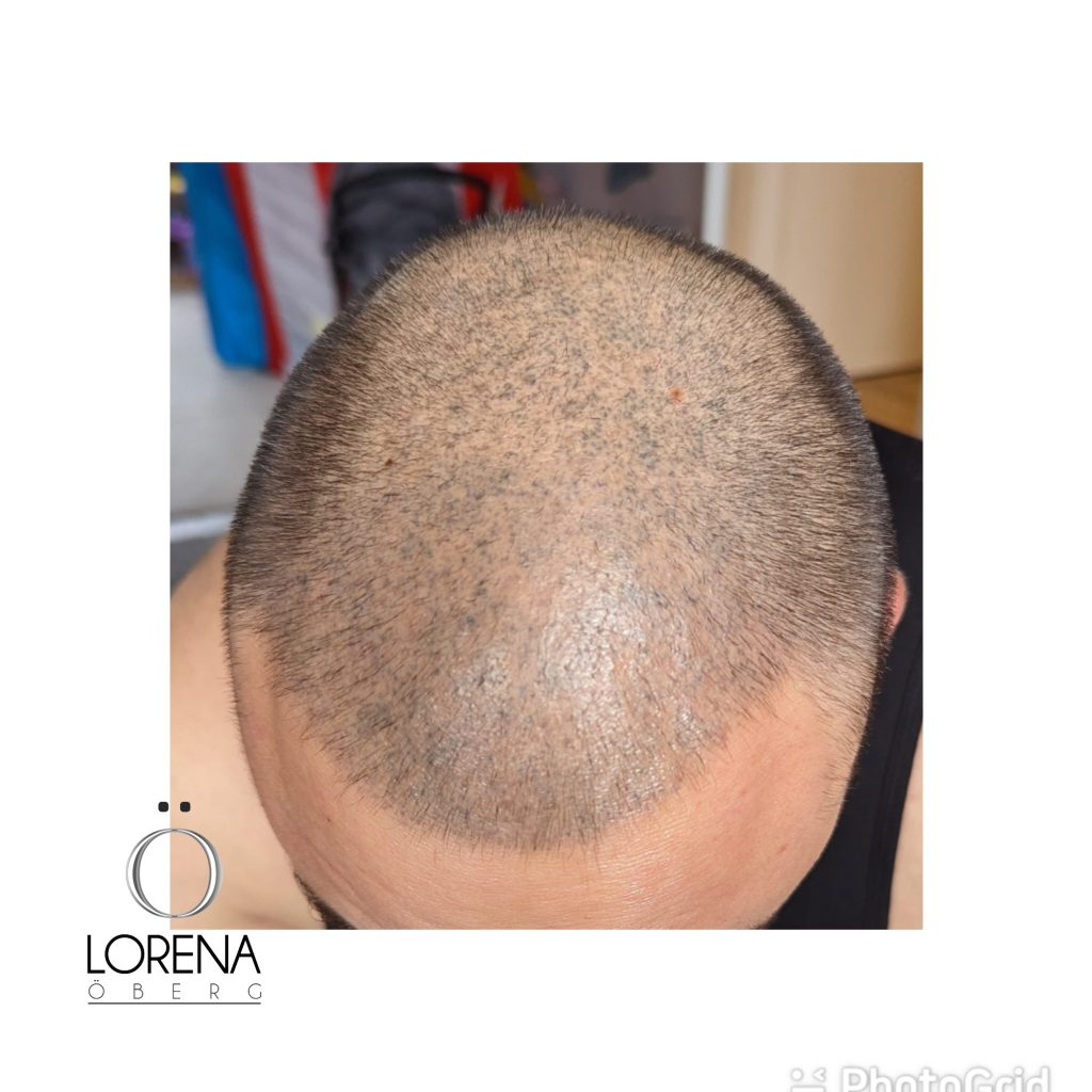 SMP scalp micro pigmentation removal expert in London