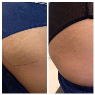DermaEraze stretch marks treatment on hips on asian skin before and after. London