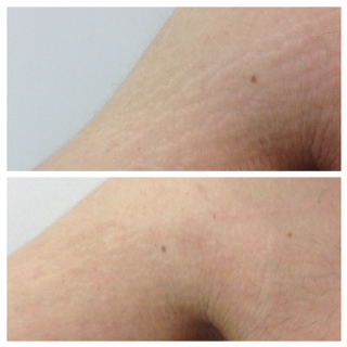 DermaEraze stretch marks removal treatment on arms before and after.  London
