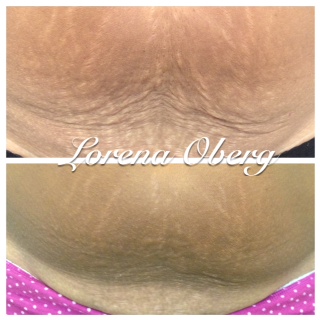 DermaEraze Stretch marks removal treatment on pregnancy stretch marks.  Before and after, London