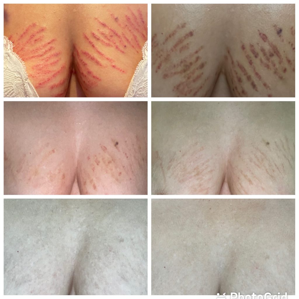 DermaEraze stretch marks removal treatment healing process from week one to week four, beofre and afters in our London Clinic