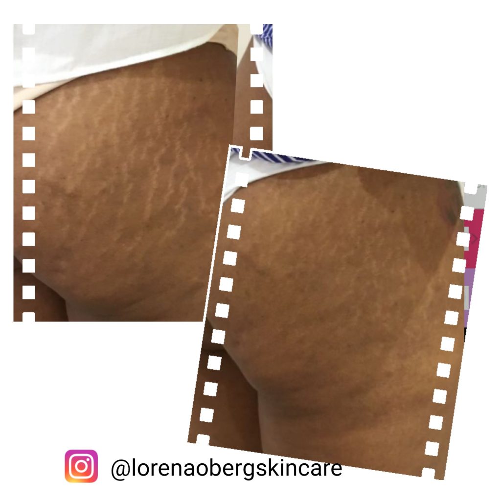 DermaEraze Stretch Marks removal treatment on buttock area on dark skin before and after in London