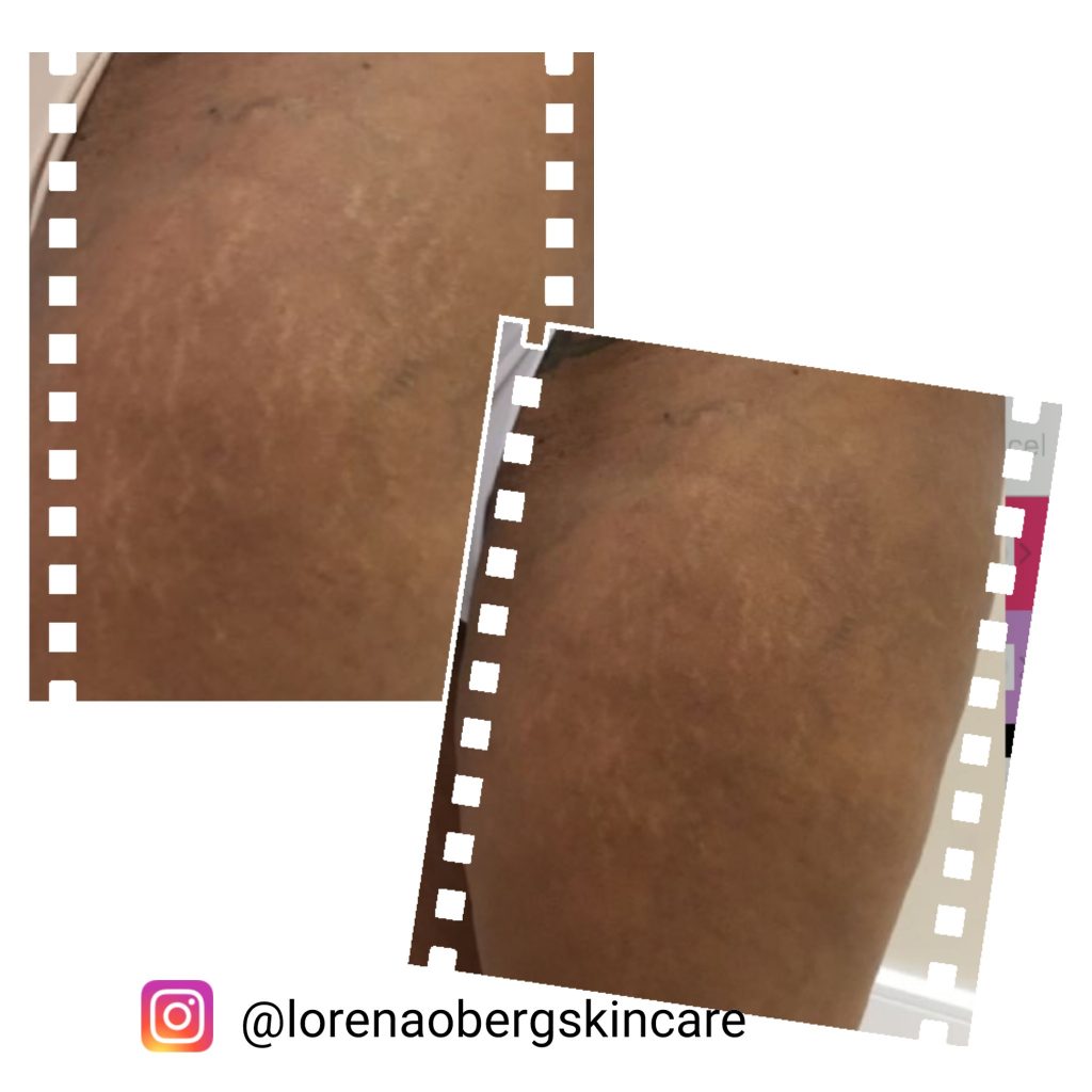 DermaEraze stretch marks removal treatment on dark skin before and after the treatment.  London