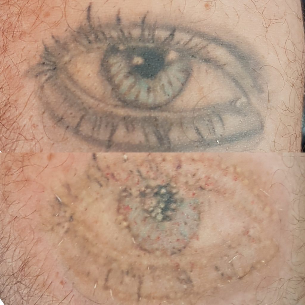 laser tattoo removal in London beore and after