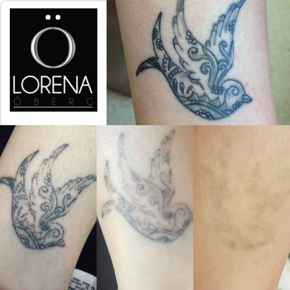 Tattoo removal process before and after treatment