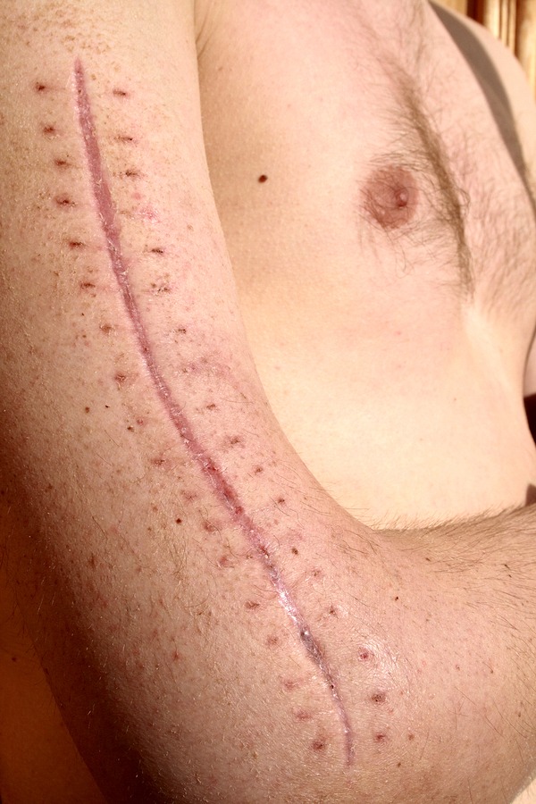 Accident scar removal treatment in London