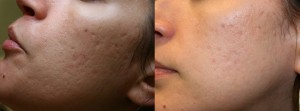 dermaeraze acne scar removal microneedling before and after