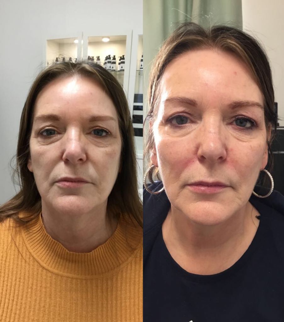 Dermal fillers in London before and after.