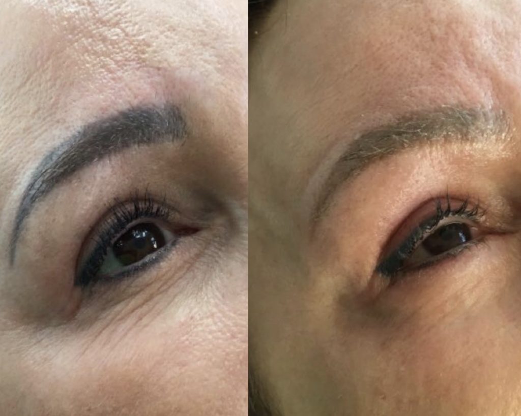 brows and eyeliner removal laser