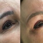 brows and eyeliner removal laser