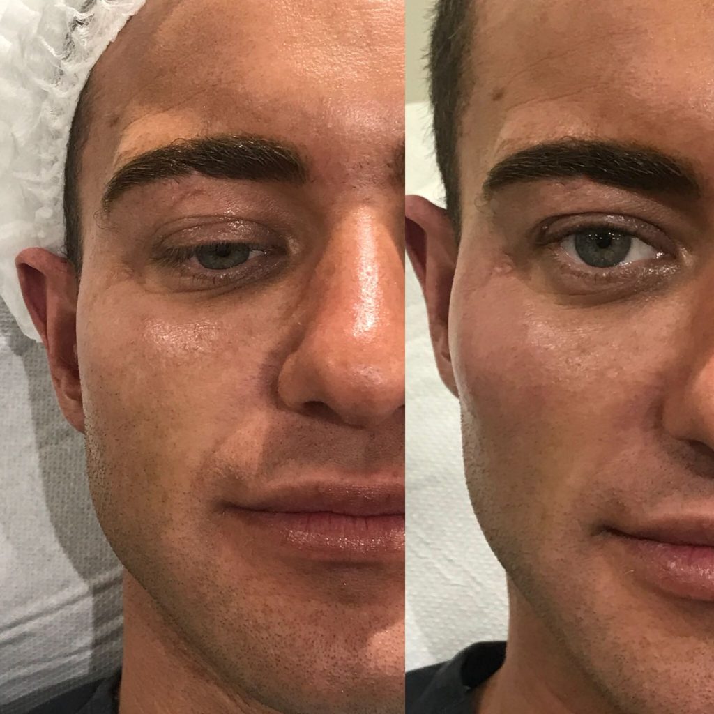 cheekbone dermal filler on men male over 30 before and after in London
