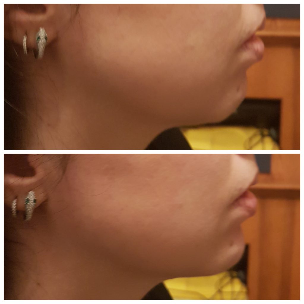 Chin filler augmentation in London before and afters