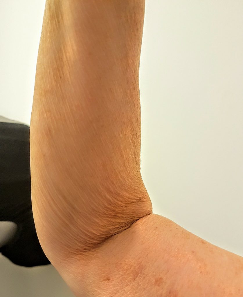 wrinkled arms treatment in London
