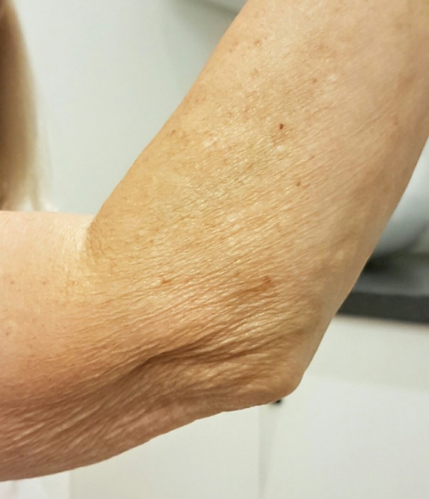 Crepey skin rejuvenation treatment in London