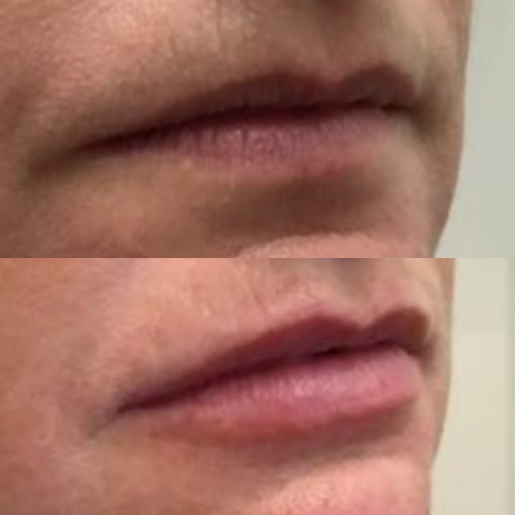 Dermal fillers in London before and after
