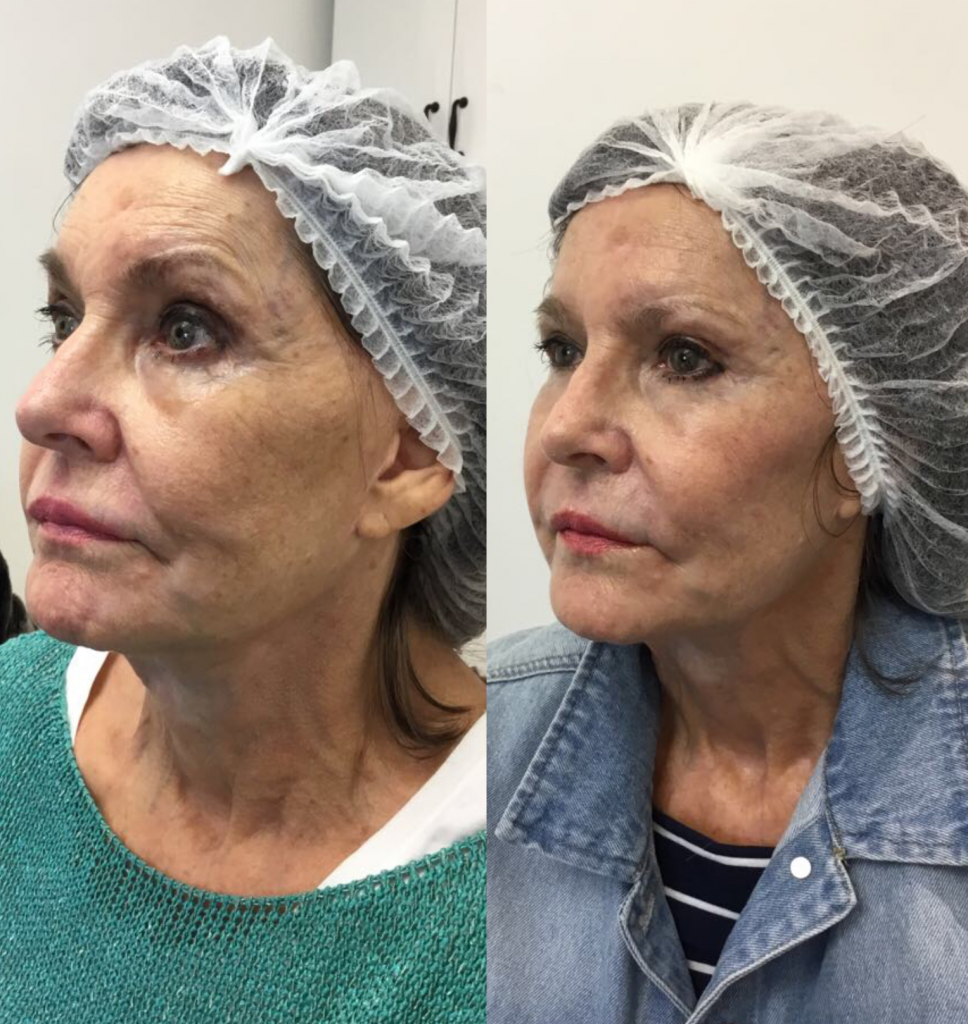dermal fillers on a lady over 50 before and after