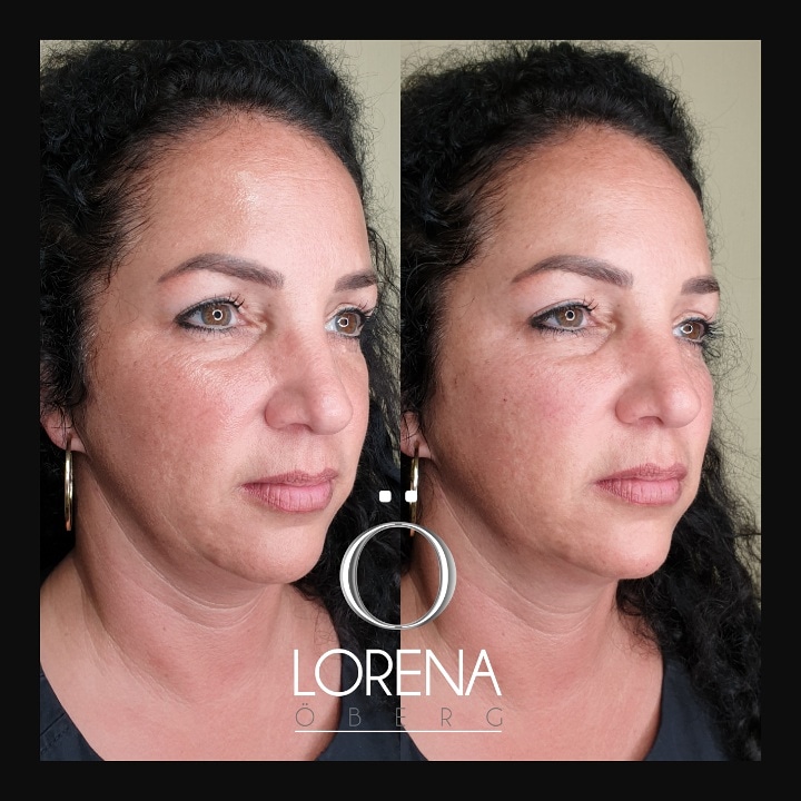 Cheek filler on over 40s before and after  in London