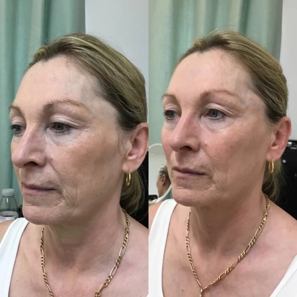 Cheek fillers on a lady over 50 to lift the face before and after in London