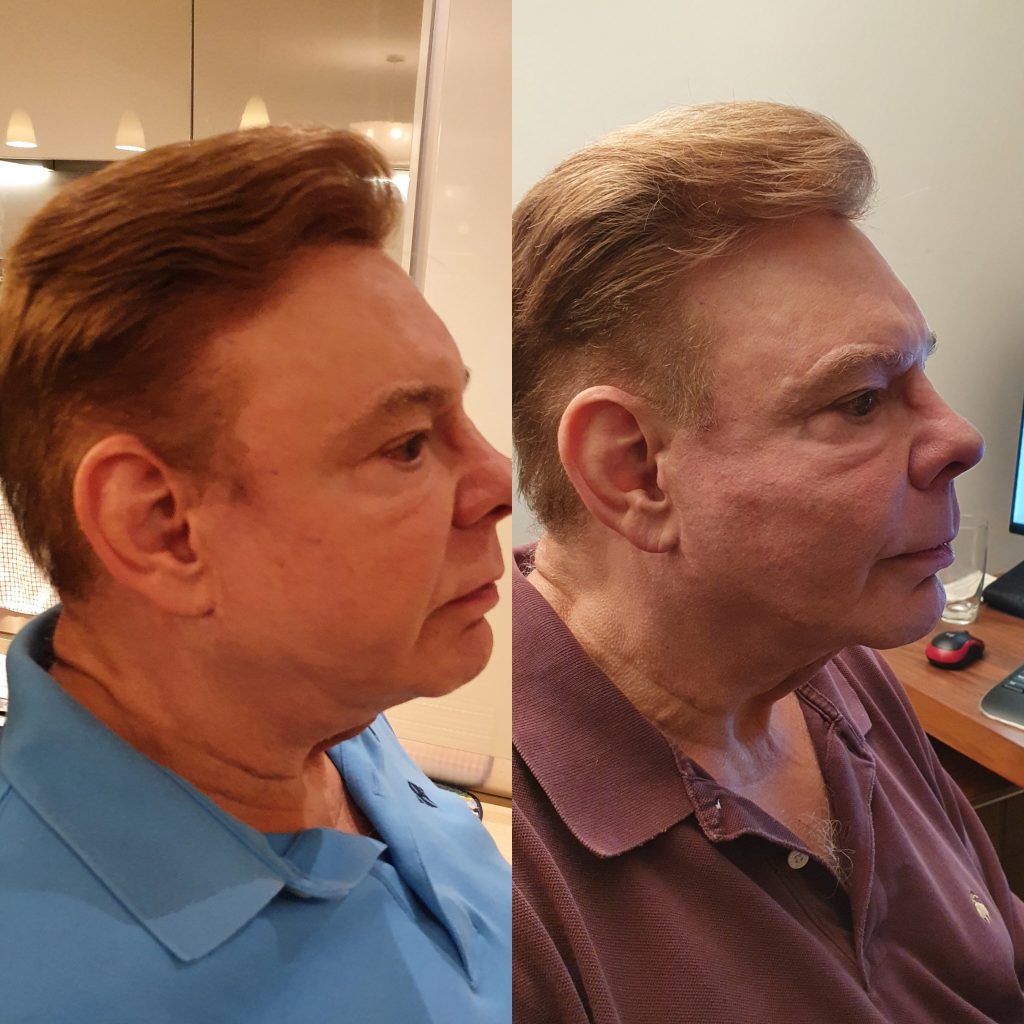 Cheek bone dermal filler before and after on male over 60 in London