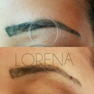 Eyebrow tattoo removal in London before and after
