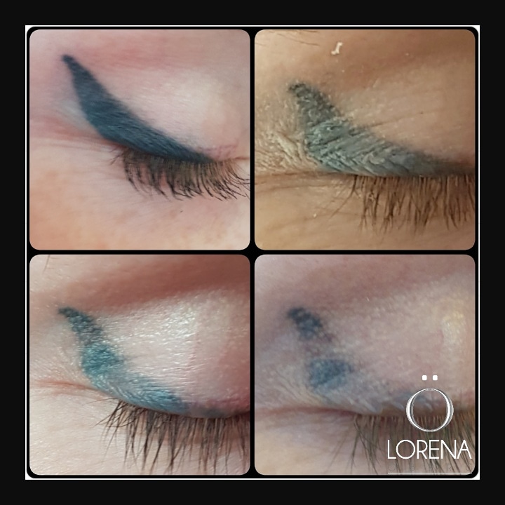 eyeliner tattoo removal process