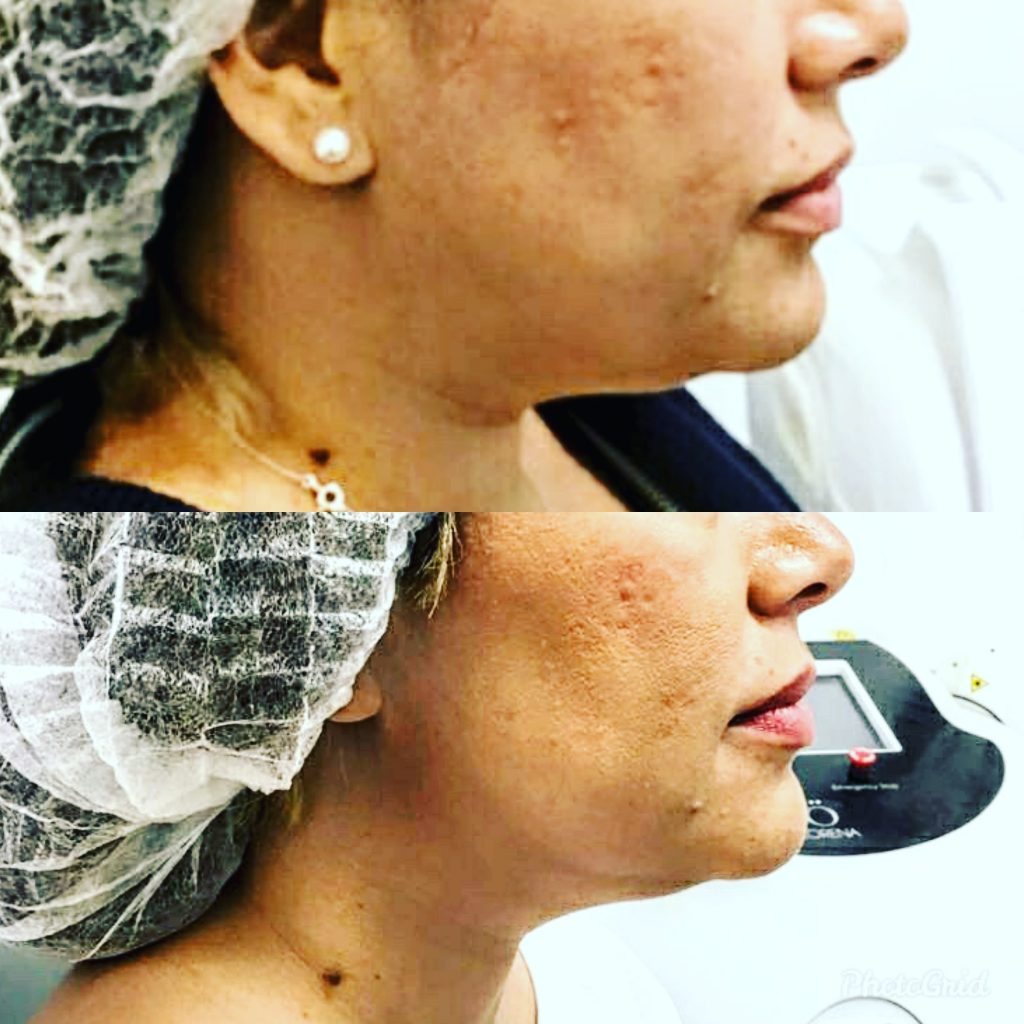 Fat dissolving injections under the chin and jowls removal before and after. 
