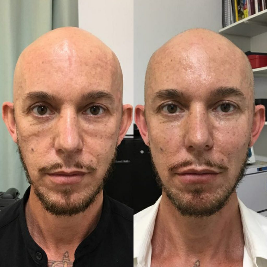 fillers for men before and after